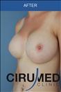 Breast Implants - Cirumed Clinic
