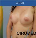 Breast Implants - Cirumed Clinic