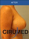 Breast Lift - Cirumed Clinic