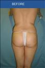 Brazilian Butt Lift - Cirumed Clinic