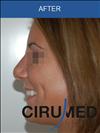 Rhinoplasty - Cirumed Clinic