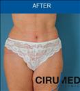 Abdominoplasty - Cirumed Clinic