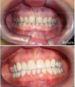 before-after - Cancun Cosmetic Dentistry