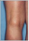 Sclerotherapy - RVB Cosmetic Surgery and Skin Care Center