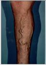Sclerotherapy - RVB Cosmetic Surgery and Skin Care Center