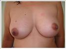 Breast Augmentation - RVB Cosmetic Surgery and Skin Care Center