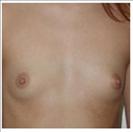 Breast Augmentation - RVB Cosmetic Surgery and Skin Care Center