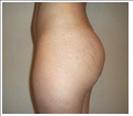 Butt Augmentation - RVB Cosmetic Surgery and Skin Care Center