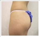 Butt Augmentation - RVB Cosmetic Surgery and Skin Care Center