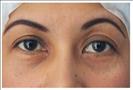 Lower Blepharoplasty - RVB Cosmetic Surgery and Skin Care Center