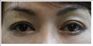 Upper and Lower Blepharoplasty - RVB Cosmetic Surgery and Skin Care Center