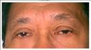 Upper & Lower Blepharoplasty - RVB Cosmetic Surgery and Skin Care Center