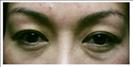 Upper and Lower Blepharoplasty - RVB Cosmetic Surgery and Skin Care Center