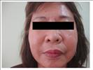 Facelift - RVB Cosmetic Surgery and Skin Care Center