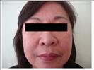 Facelift - RVB Cosmetic Surgery and Skin Care Center