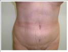 Liposuction - Abdomen - RVB Cosmetic Surgery and Skin Care Center
