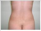 Liposuction - Back - RVB Cosmetic Surgery and Skin Care Center