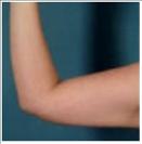 Lipsuction - Arms - RVB Cosmetic Surgery and Skin Care Center