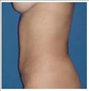 Liposuction - Abdomen - RVB Cosmetic Surgery and Skin Care Center