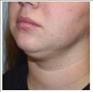 Liposuction - Arms - RVB Cosmetic Surgery and Skin Care Center