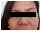 Rhinoplasty - RVB Cosmetic Surgery and Skin Care Center