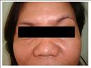 Rhinoplasty - RVB Cosmetic Surgery and Skin Care Center