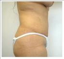 Tummy Tuck - RVB Cosmetic Surgery and Skin Care Center