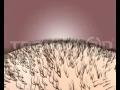Hair Transplantation Techniques FUT and FUE