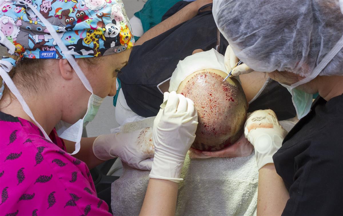 Force Hair Transplant