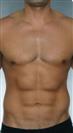 Six Pack - Estethica Surgical Medical Center
