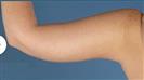 Arm Lift - Estethica Surgical Medical Center