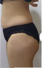 Brazilian Butt Lift - Estethica Surgical Medical Center