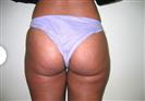 Brazilian Butt Lift - Estethica Surgical Medical Center
