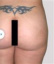 Brazilian Butt Lift - Estethica Surgical Medical Center