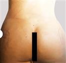 Brazilian Butt Lift - Estethica Surgical Medical Center
