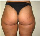 Brazilian Butt Lift - Estethica Surgical Medical Center