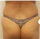 Brazilian Butt Lift - Estethica Surgical Medical Center