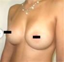 Breast Augmentation - Estethica Surgical Medical Center