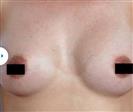 Breast Augmentation - Estethica Surgical Medical Center