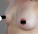Breast Augmentation - Estethica Surgical Medical Center
