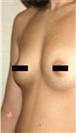Breast Augmentation - Estethica Surgical Medical Center