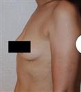 Breast Augmentation - Estethica Surgical Medical Center