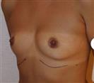 Breast Augmentation - Estethica Surgical Medical Center