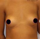 Breast Augmentation - Estethica Surgical Medical Center