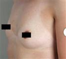 Breast Augmentation - Estethica Surgical Medical Center