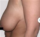 Breast Lift - Estethica Surgical Medical Center
