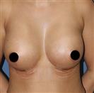 Breast Reduction - Estethica Surgical Medical Center