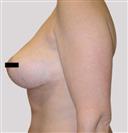 Breast Reduction - Estethica Surgical Medical Center