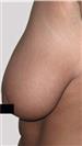 Breast Reduction - Estethica Surgical Medical Center