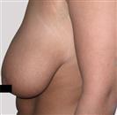 Breast Reduction - Estethica Surgical Medical Center